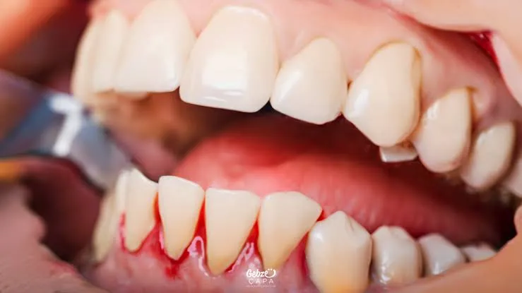 Diş eti kanaması önemsiz bir durum değil!